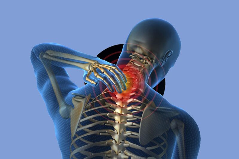 Dolor de cuello en la osteocondrosis