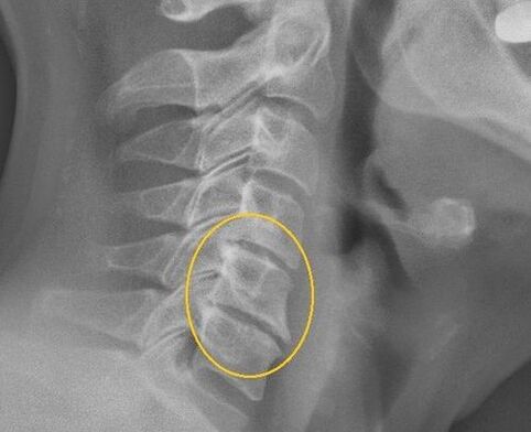 Osteocondrosis de la columna cervical en un rayos X