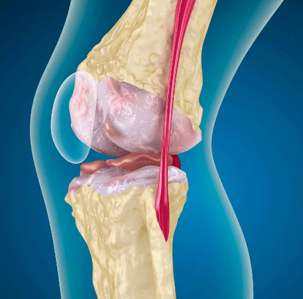 Artrrosis de la articulación de la rodilla