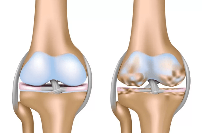 Deformación de la artrosis de la articulación de la rodilla