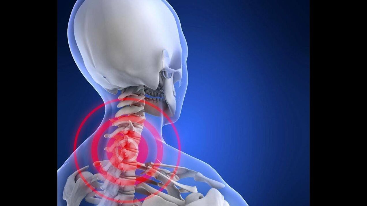 Osteocondrosis de la columna cervical.