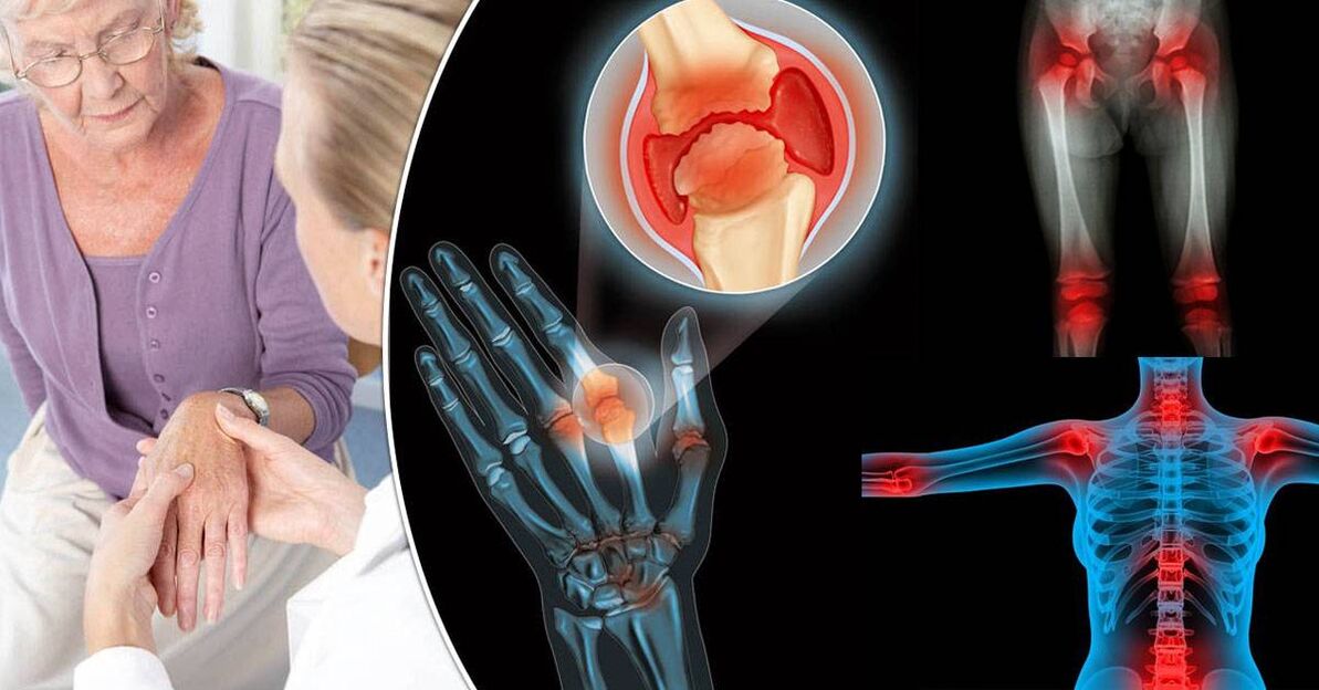 ¿Qué es la osteoartritis